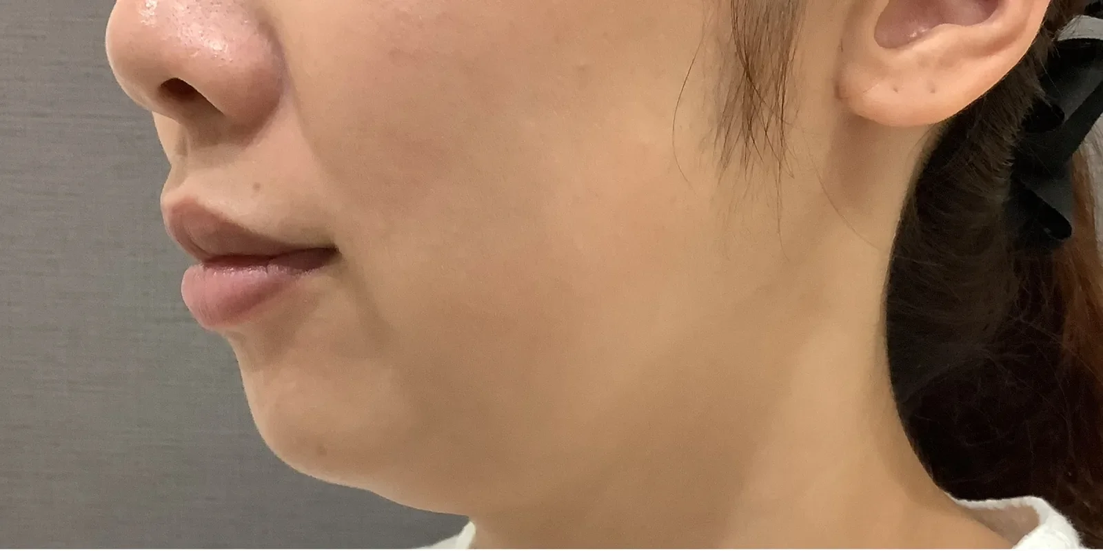 リヴァイブ 顎下 Before/After Before