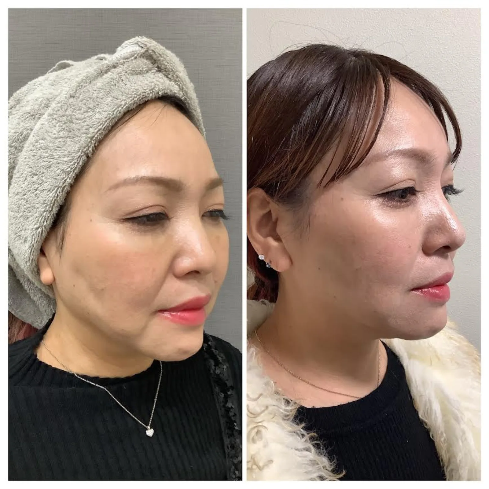 リヴァイブ（Re:vive） 症例写真 2 — 顔全体（リフトアップ）