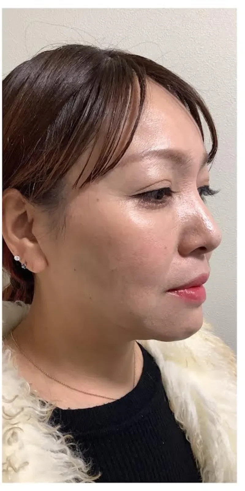 リヴァイブ 顔全体 症例A Before/After After