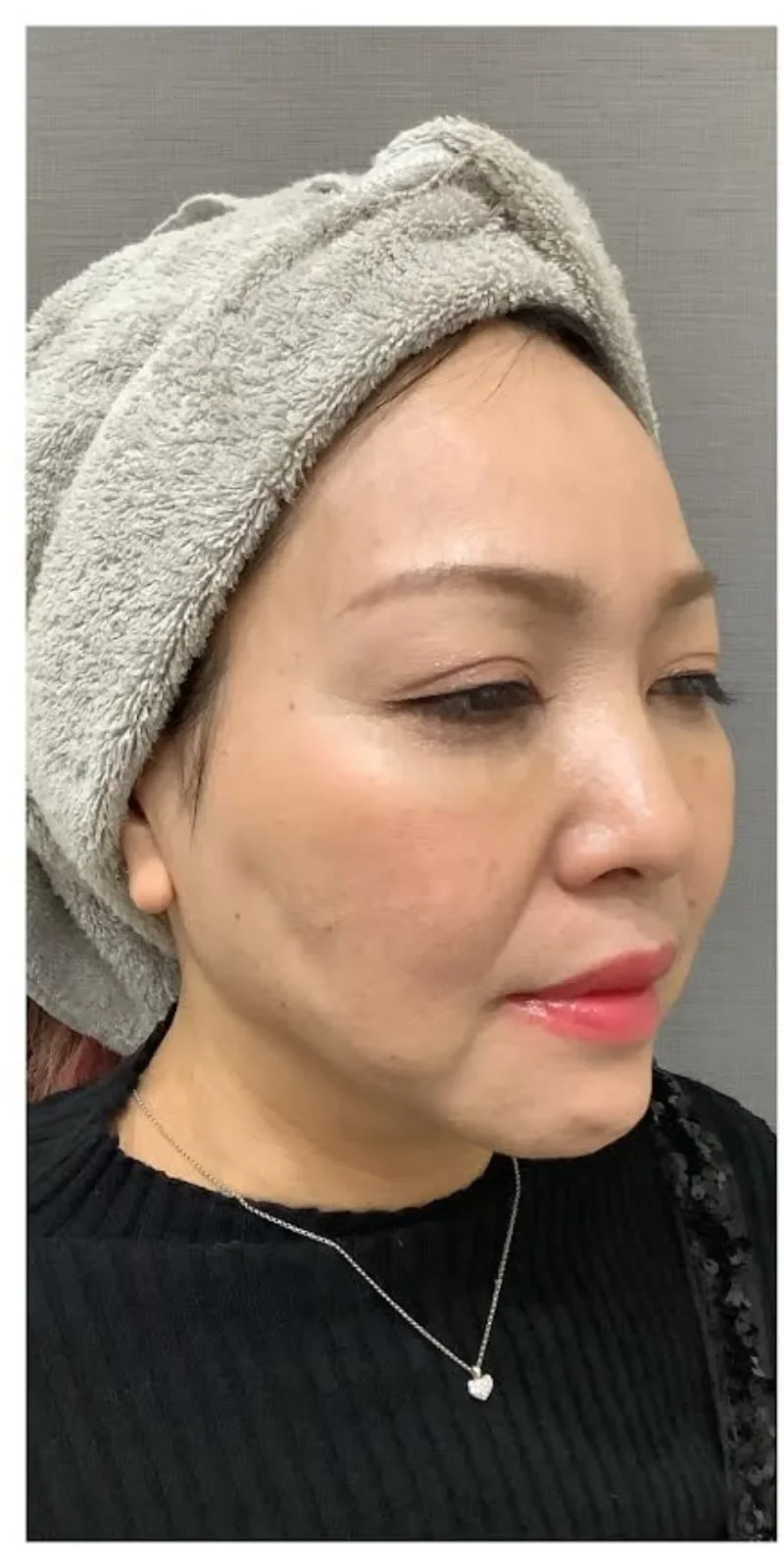 リヴァイブ 顔全体 症例A Before/After Before