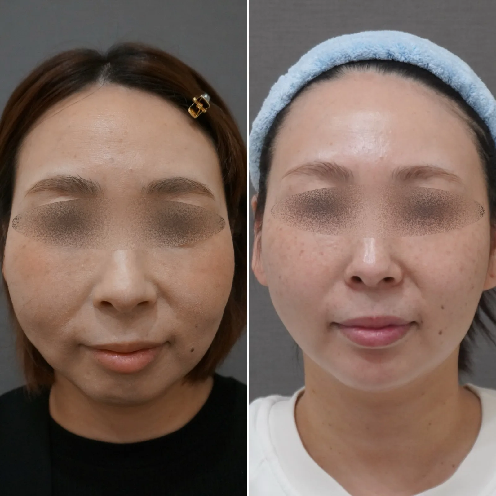 リヴァイブ（Re:vive） 症例写真 3 — 顔全体（リフトアップ）