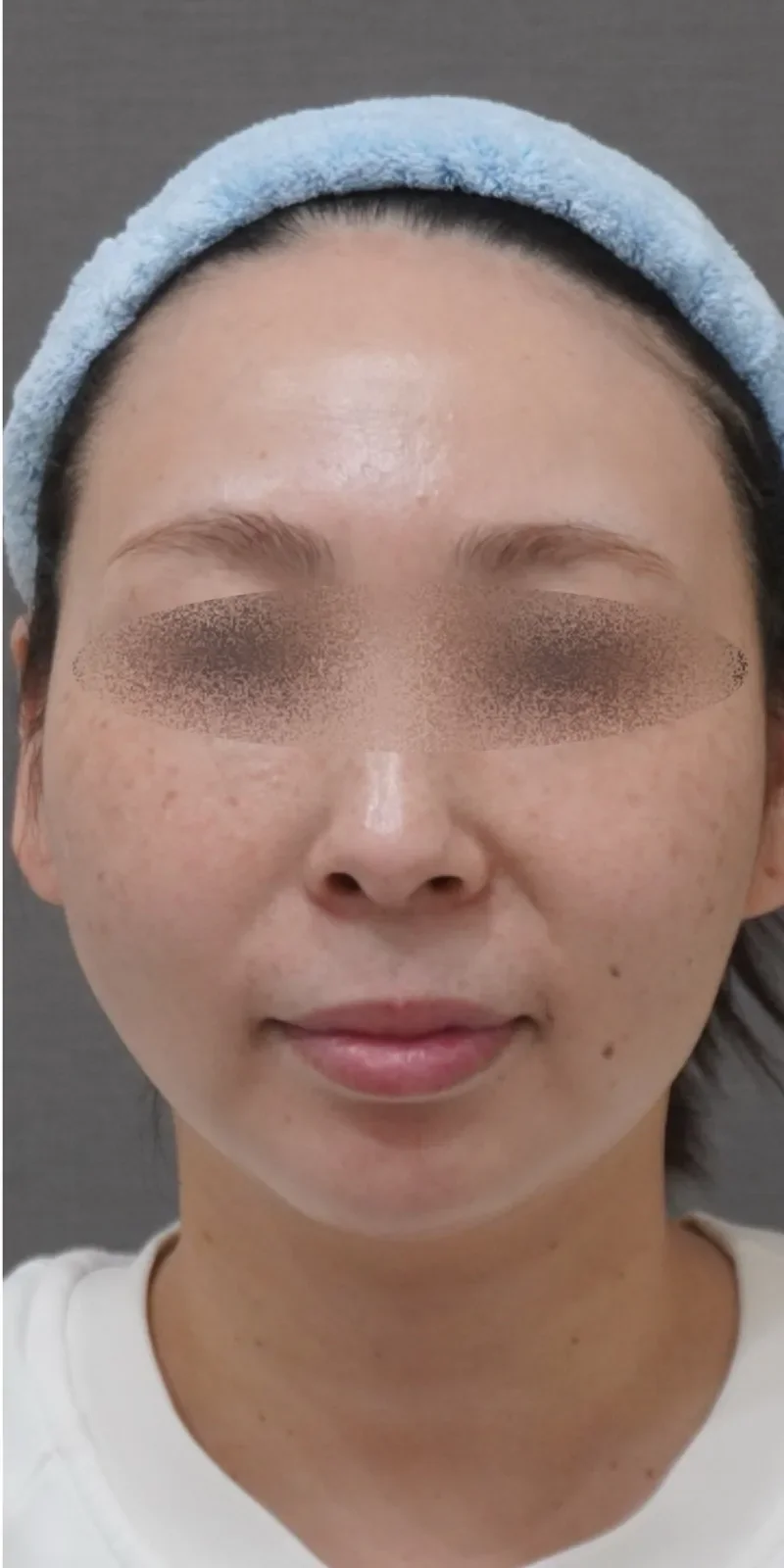 リヴァイブ 顔全体 症例B Before/After After