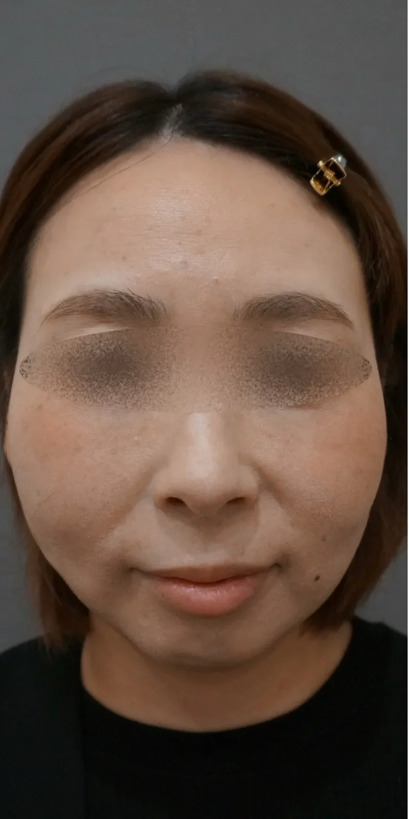 リヴァイブ 顔全体 症例B Before/After Before