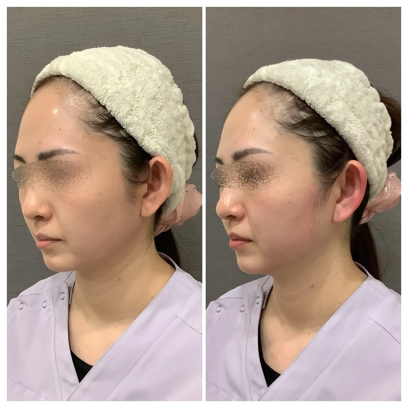 リヴァイブ（Re:vive） 症例写真 4 — フェイスライン