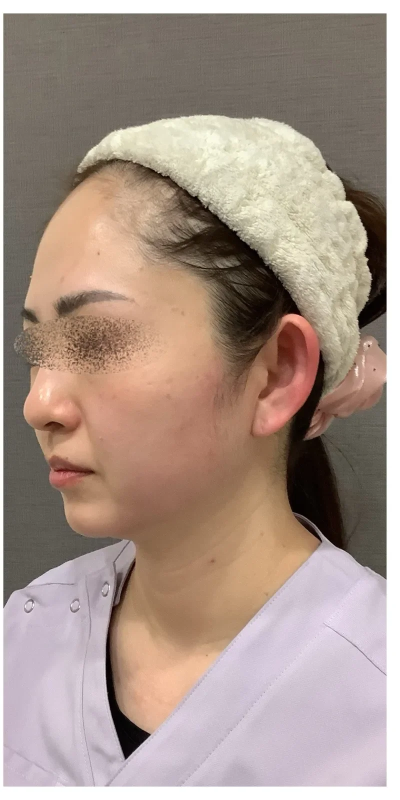 リヴァイブ フェイスライン Before/After After