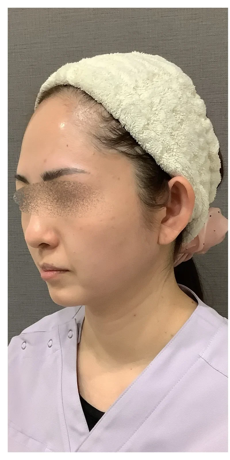 リヴァイブ フェイスライン Before/After Before