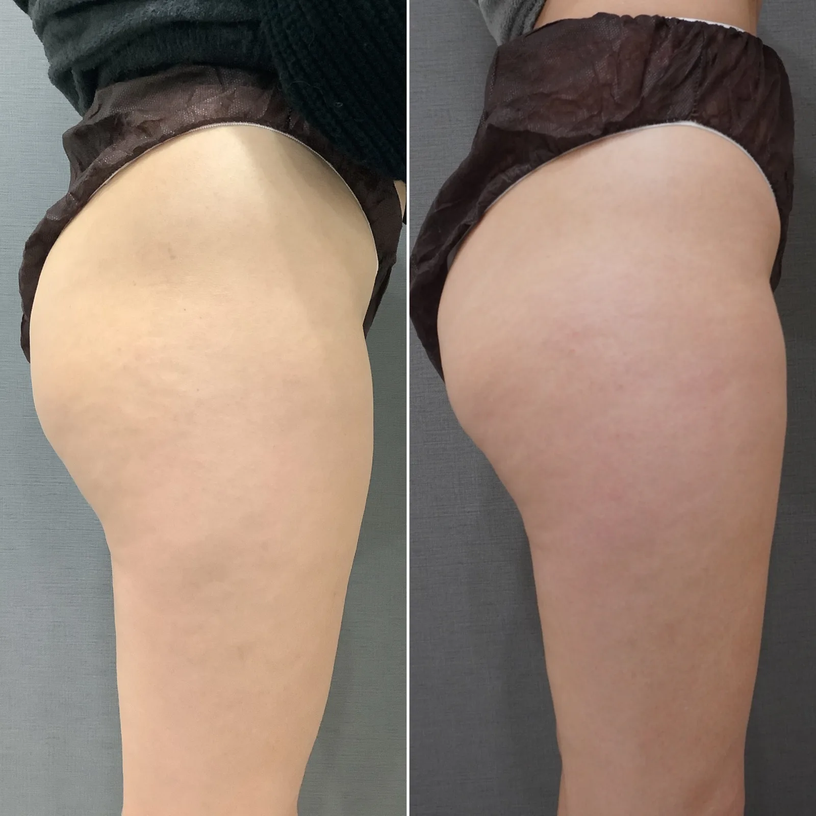 リヴァイブ（Re:vive）ボディ 症例写真 5 — ヒップ（ボディ）