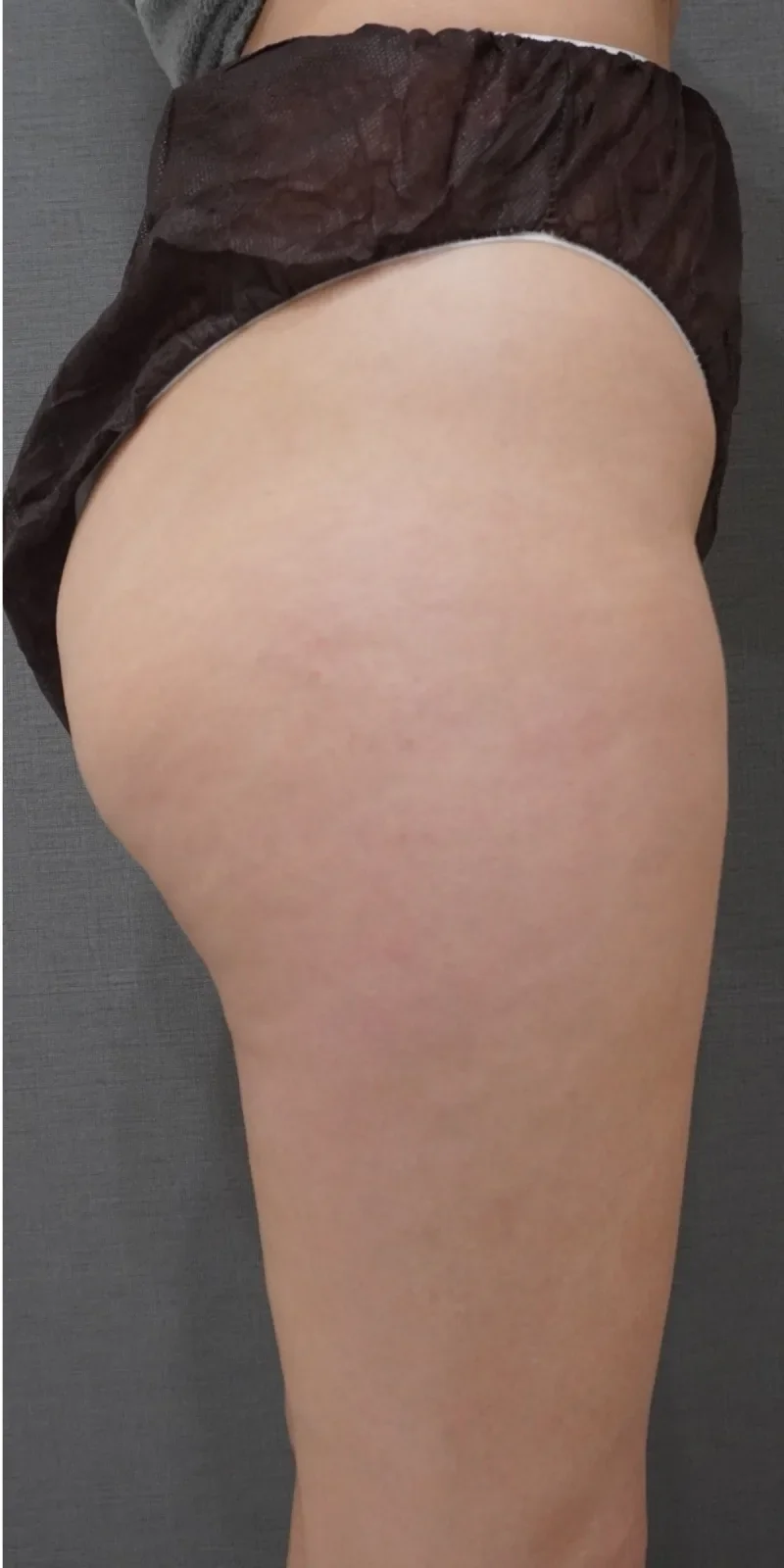 リヴァイブ ヒップ Before/After After