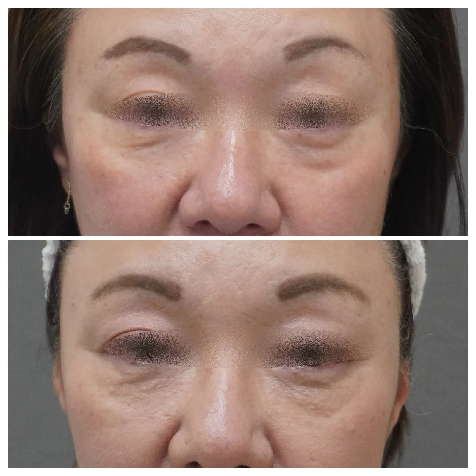 肌育注射「ベビーコラーゲン」症例2例 — 繊細な部位の小じわ・くぼみ改善