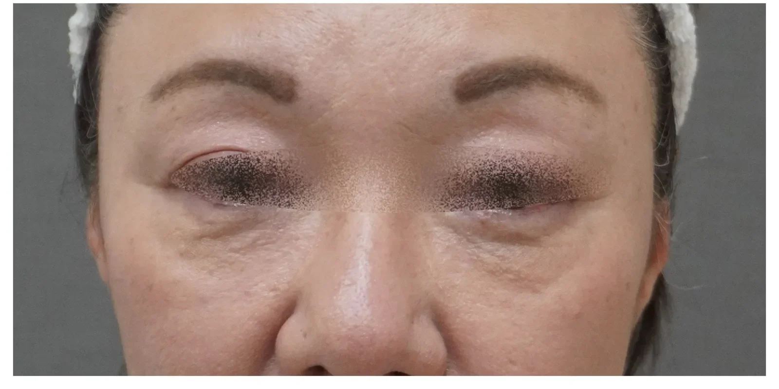 ベビーコラーゲン 症例A Before/After After