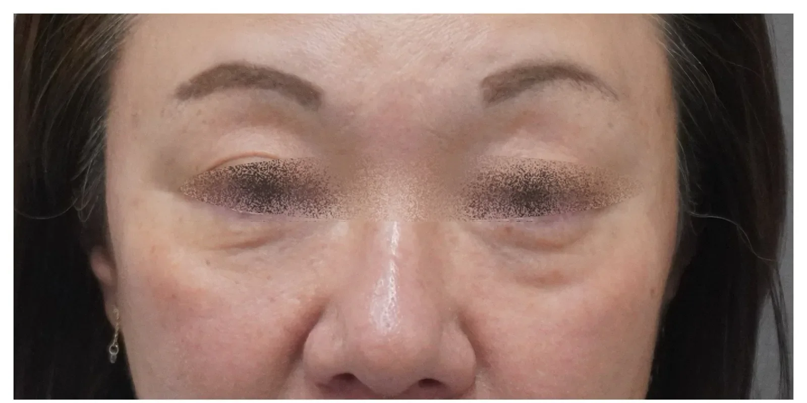 ベビーコラーゲン 症例A Before/After Before