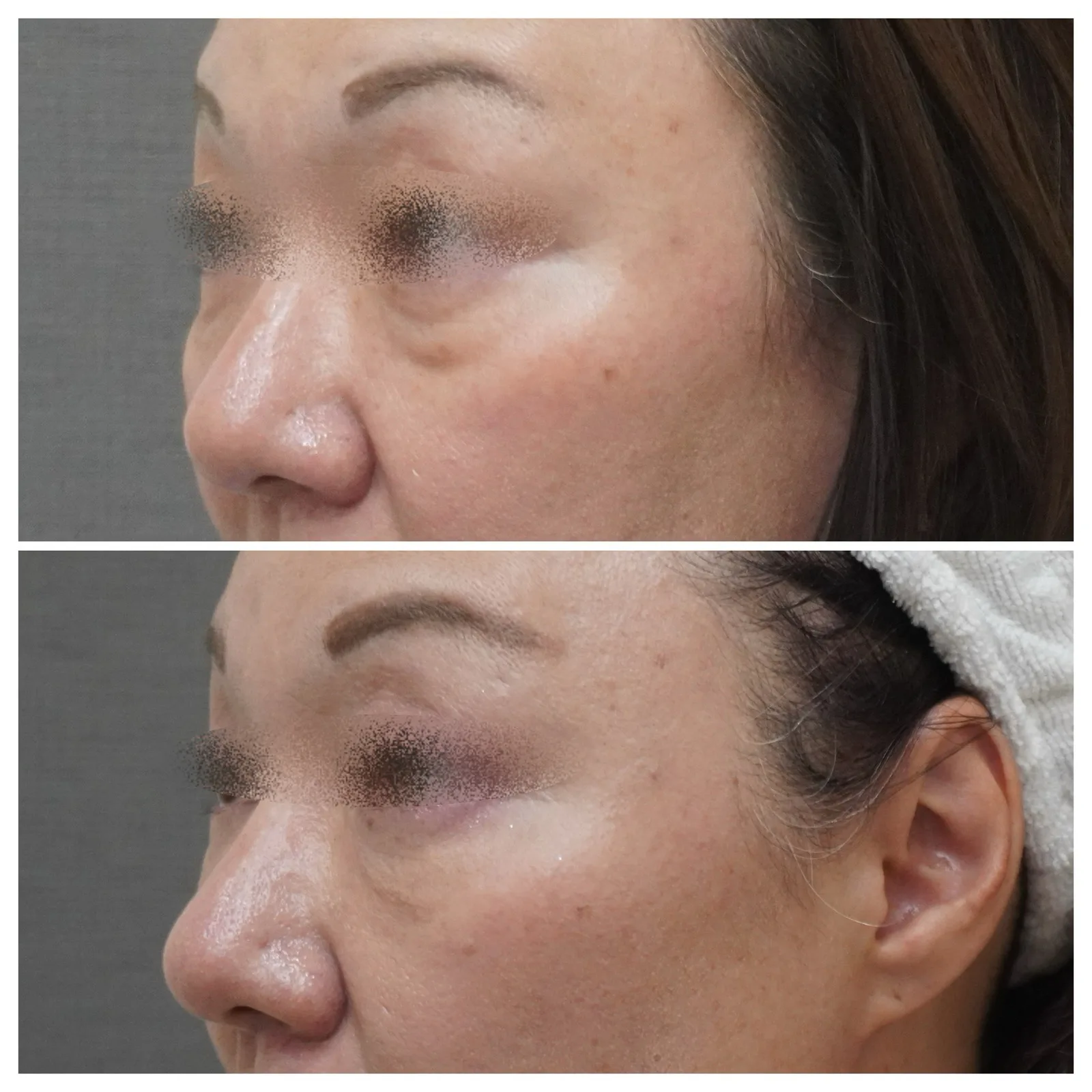 肌育注射（ベビーコラーゲン） 症例写真 4 — ベビーコラーゲン