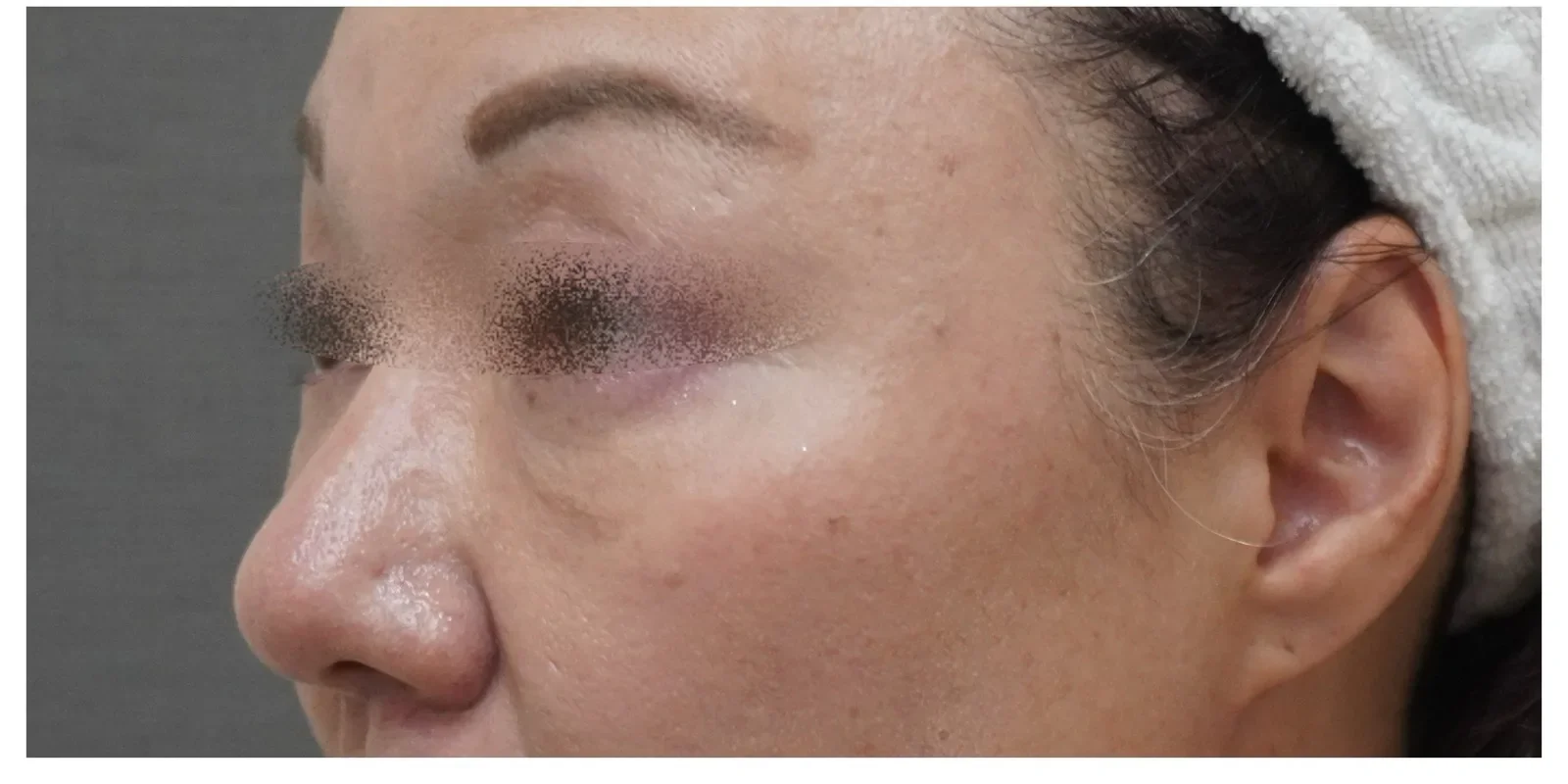 ベビーコラーゲン 症例B Before/After After