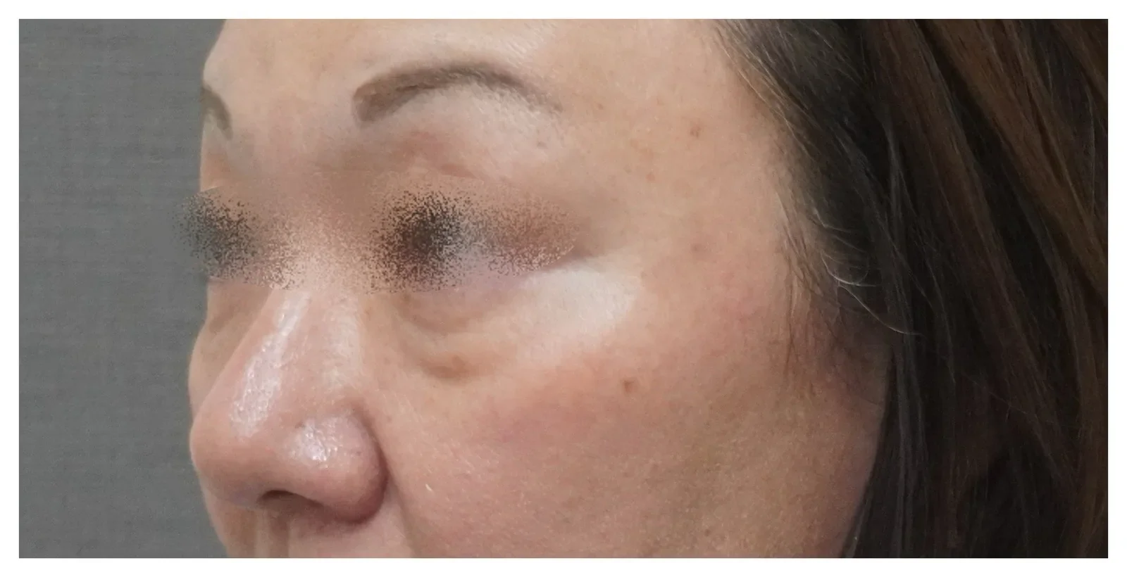 ベビーコラーゲン 症例B Before/After Before