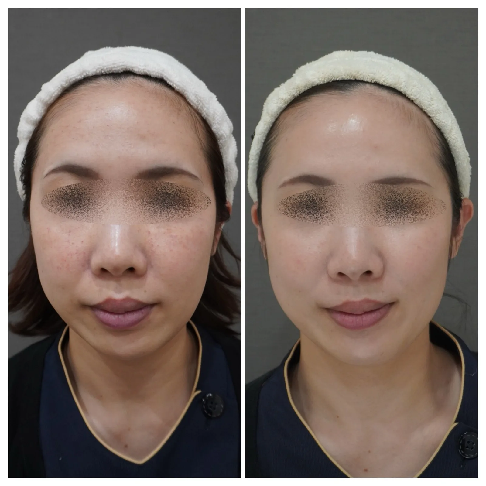 肌育注射「ジャルプロ」症例2例 — 顔と首のハリ改善