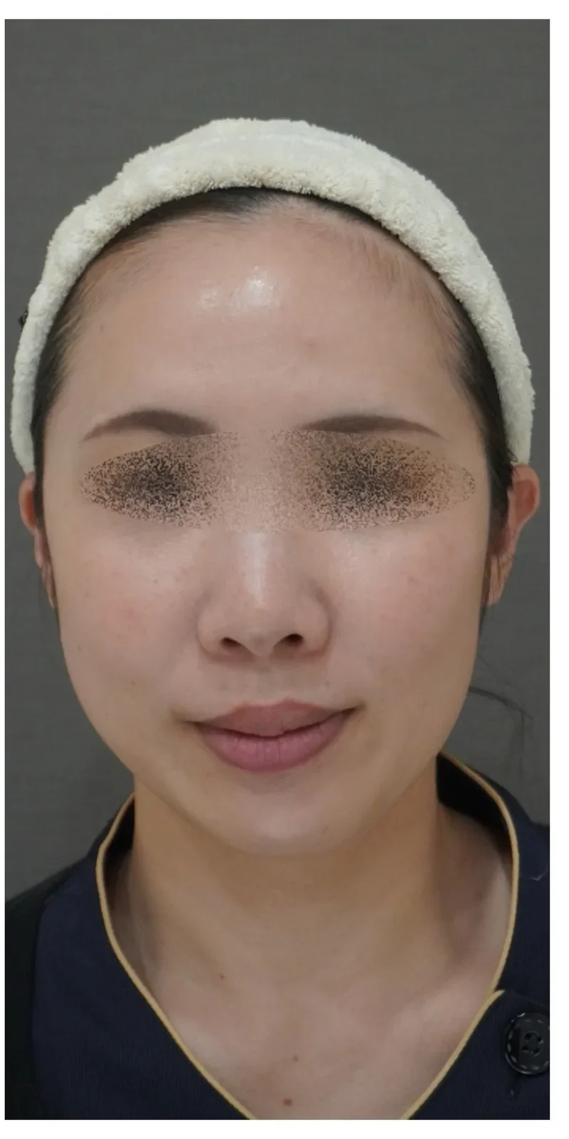 ジャルプロ 顔 Before/After After