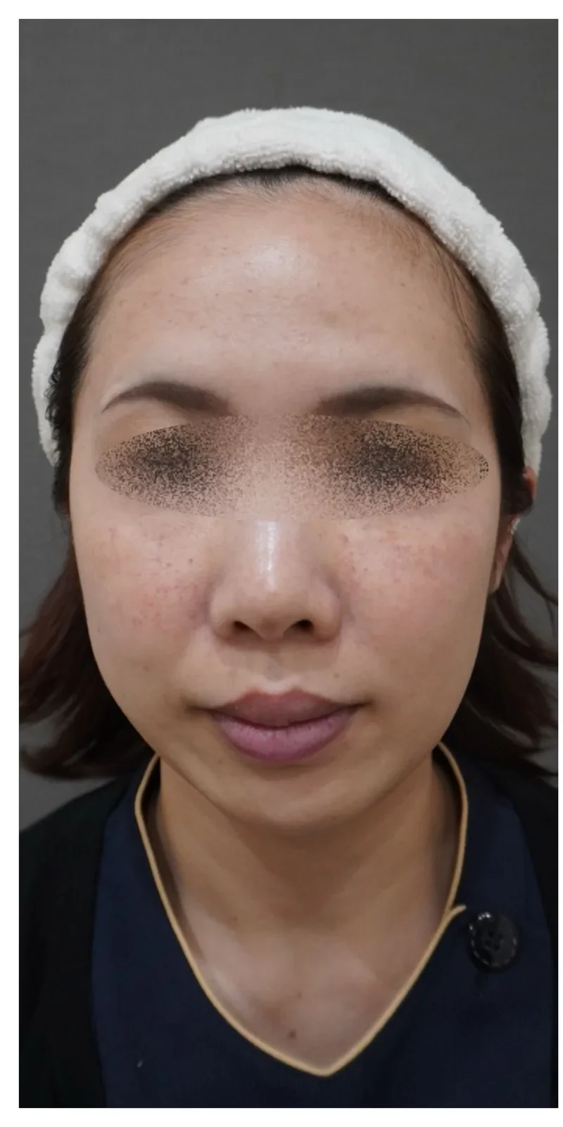 ジャルプロ 顔 Before/After Before