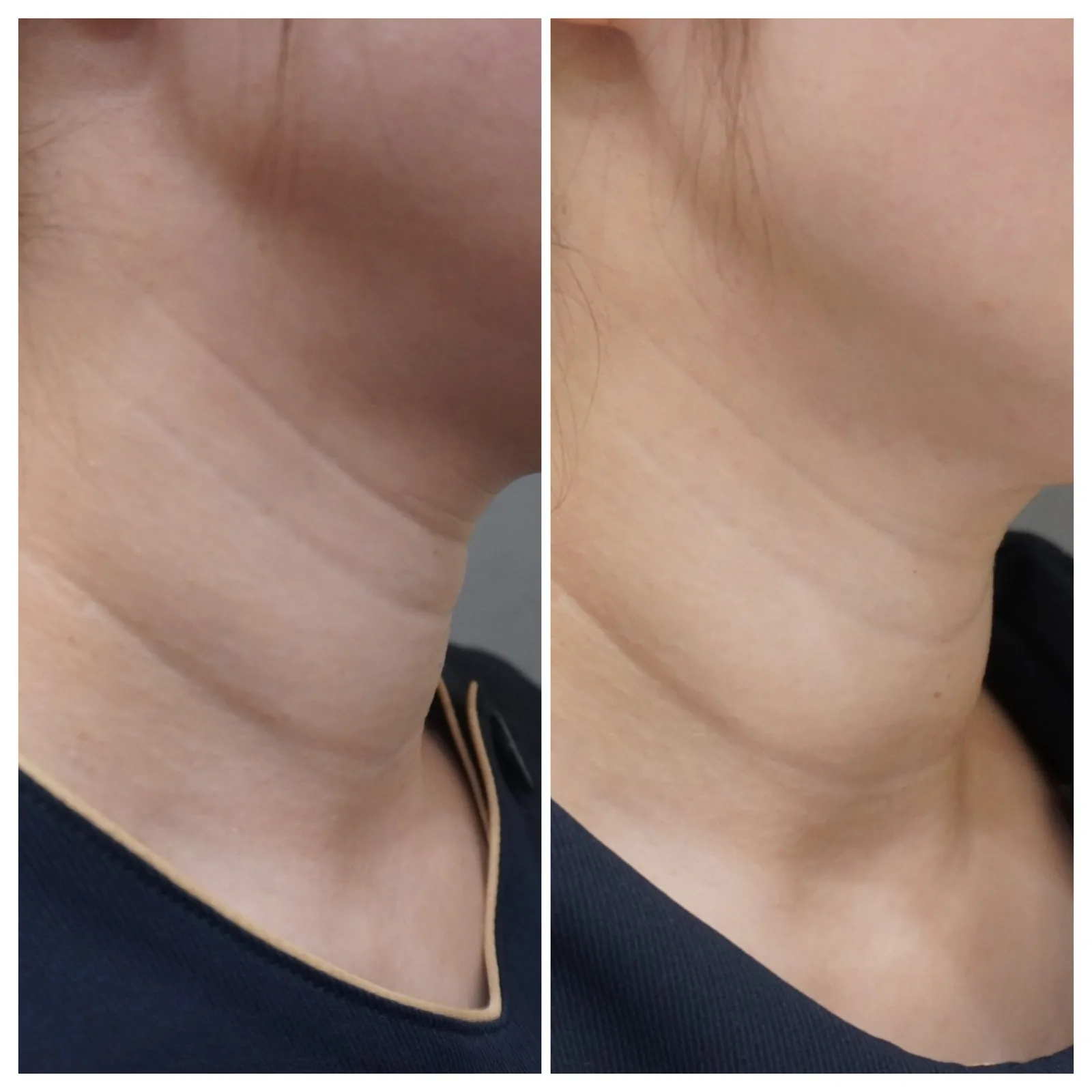 肌育注射（ジャルプロ） 症例写真 2 — ジャルプロ（首）