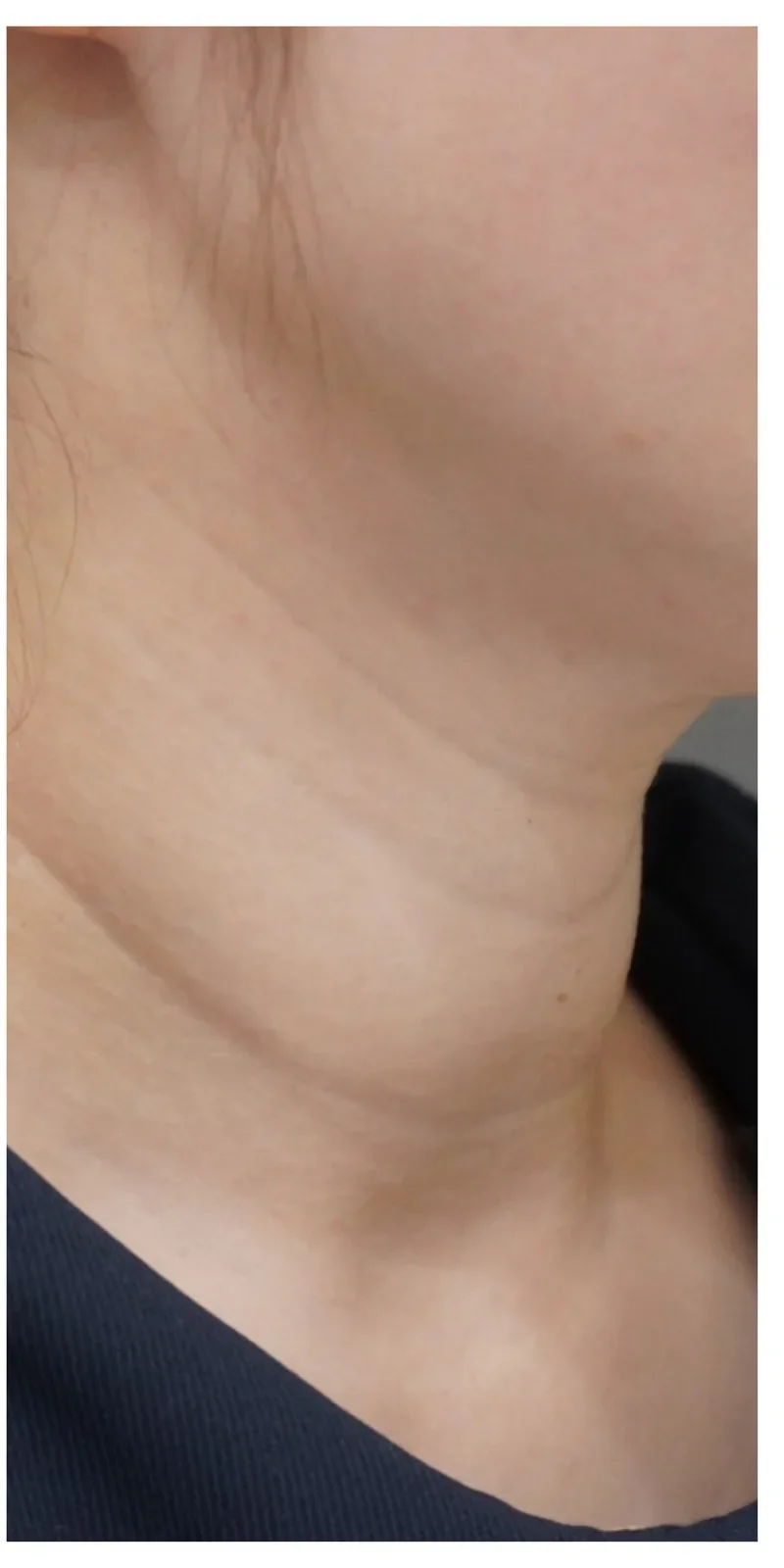 ジャルプロ 首 Before/After After