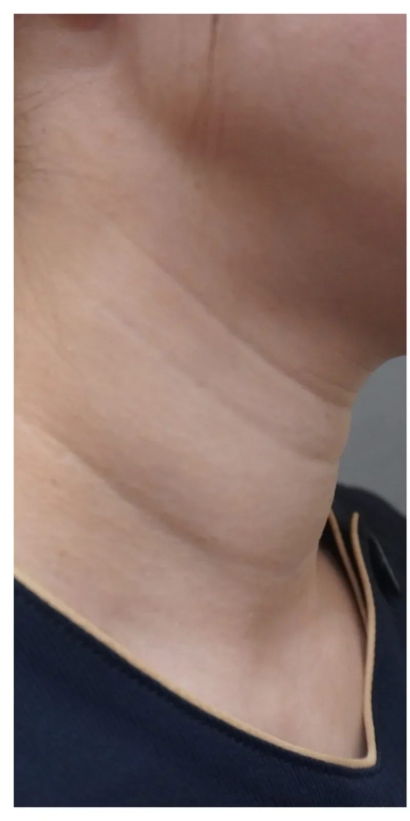 ジャルプロ 首 Before/After Before