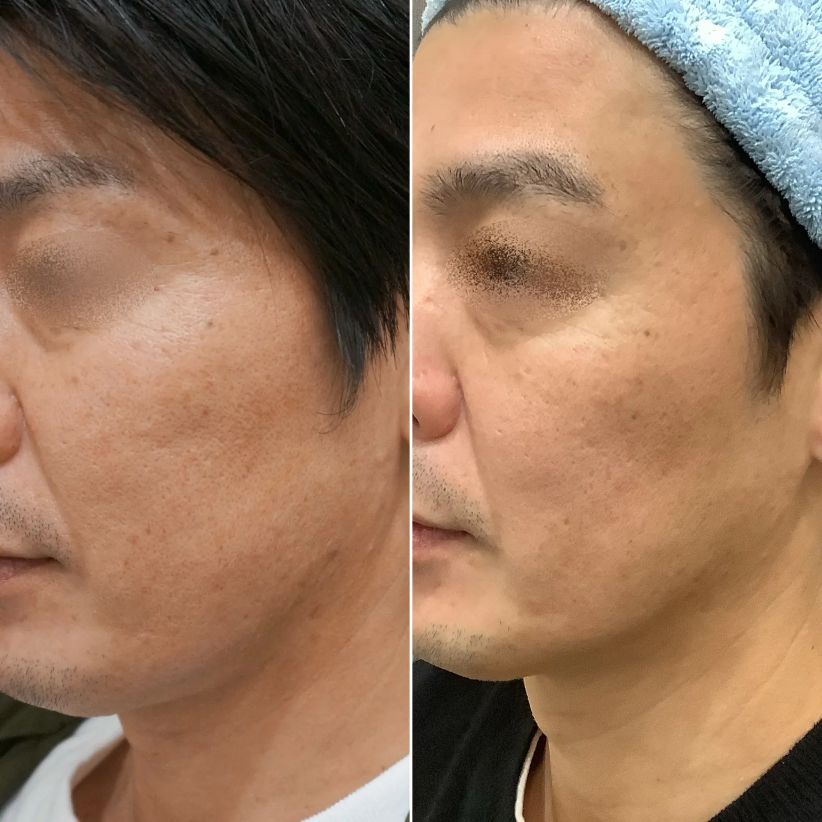 肌育注射「ジュベルック」症例 — 毛穴・ニキビ跡への応用