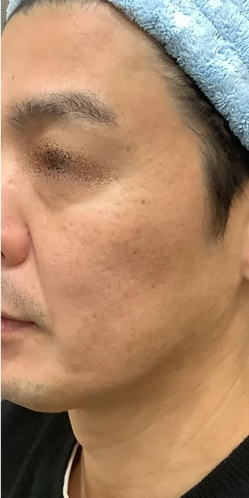 ジュベルック Before/After After