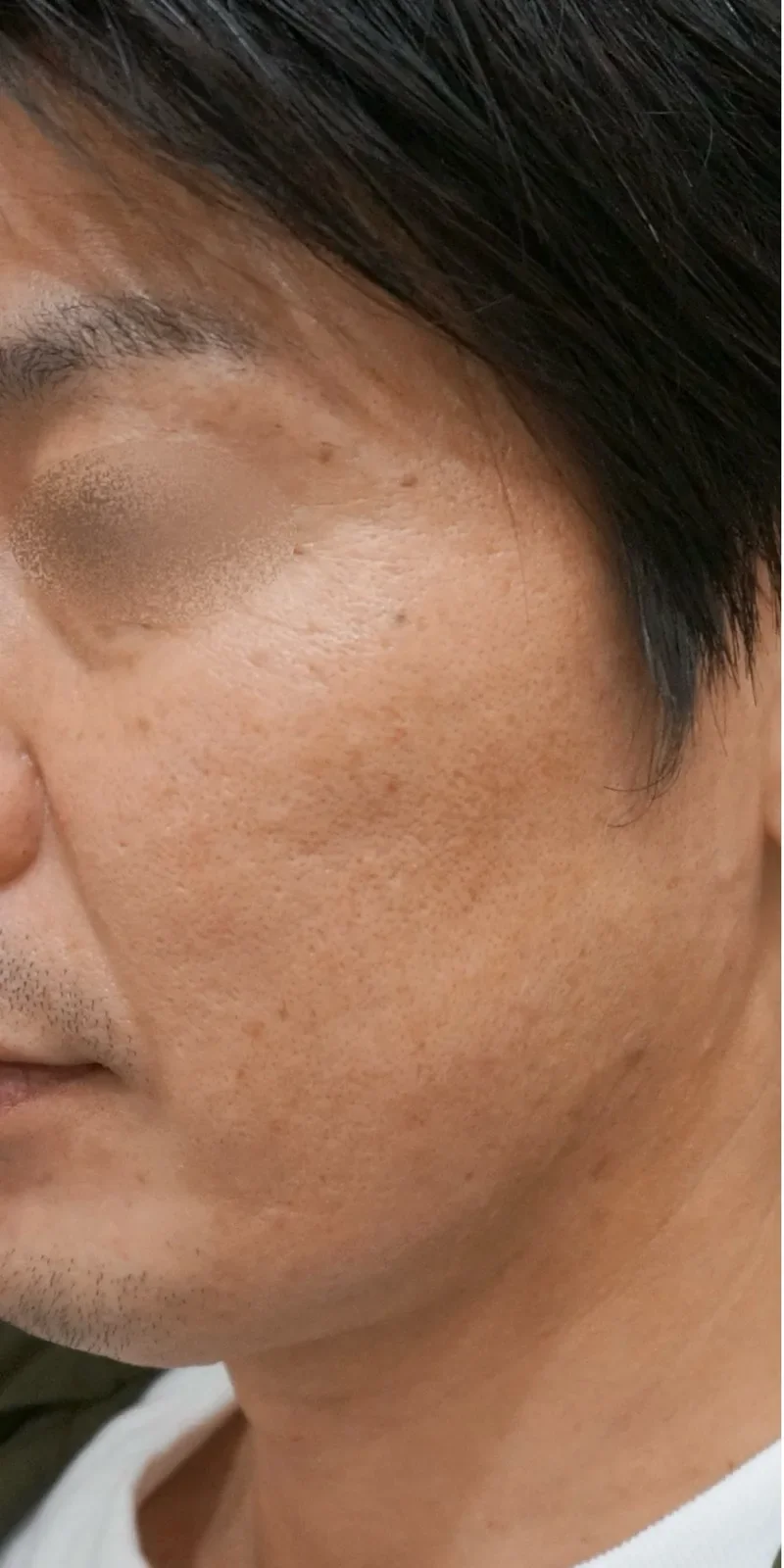 ジュベルック Before/After Before