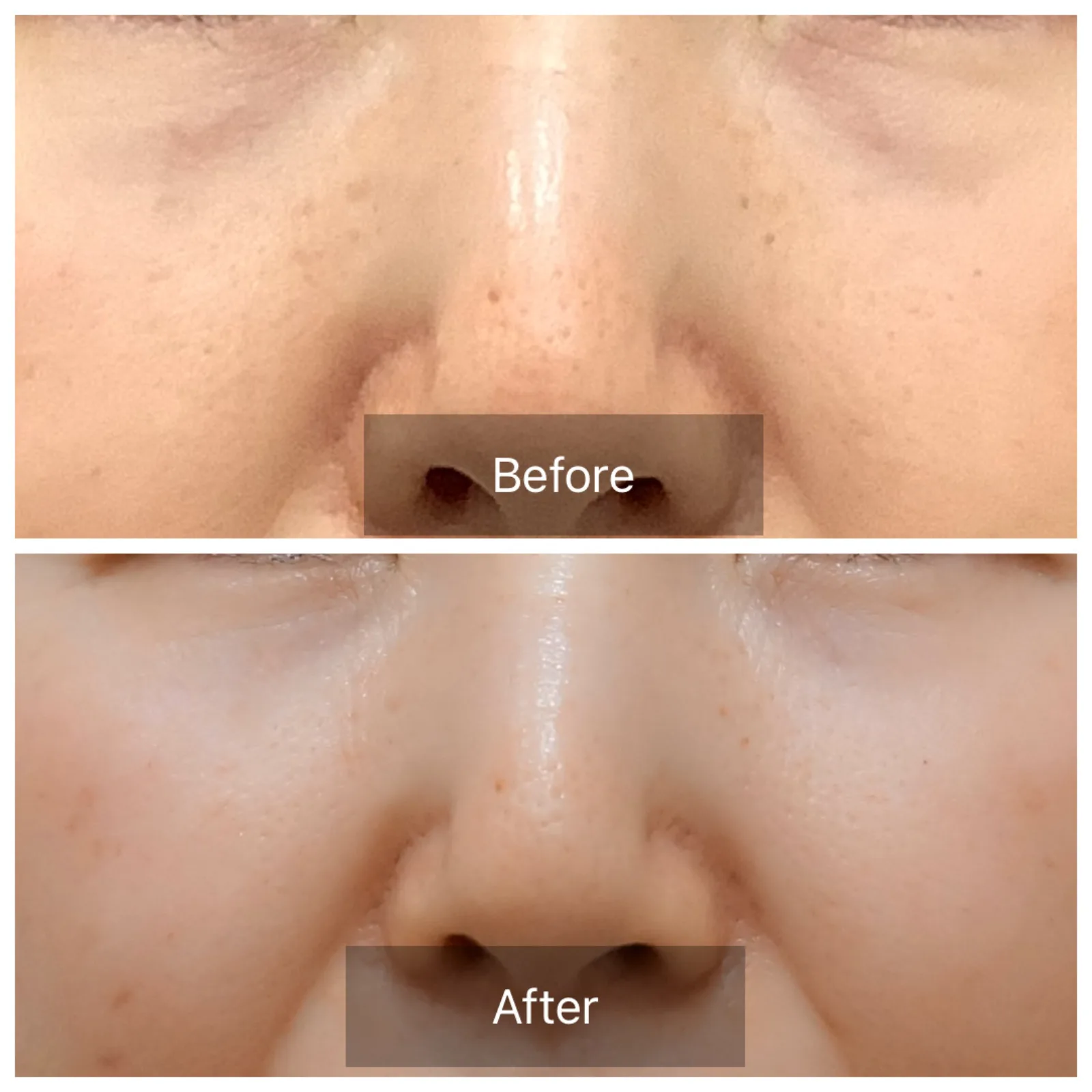 肌育注射「リズネ（Rejuran）」症例2例 — 目元のハリ改善