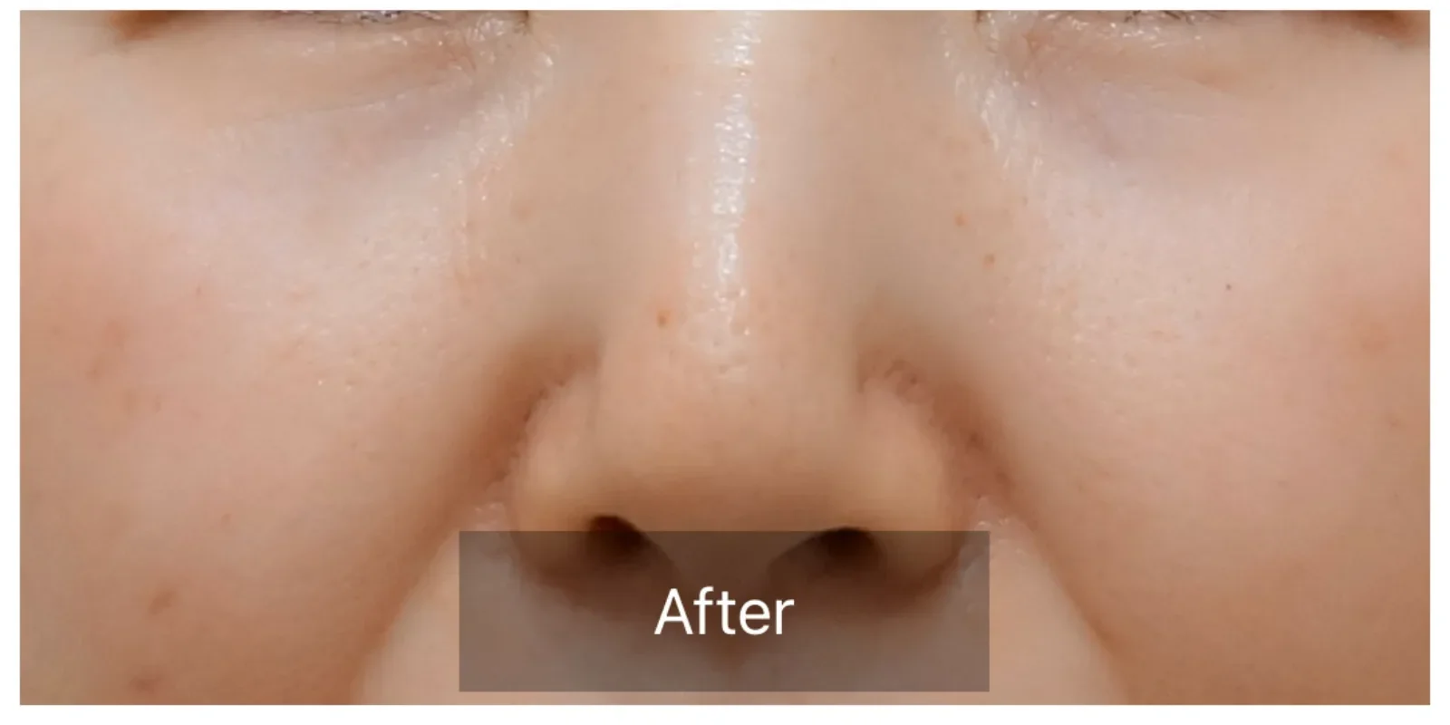 リズネ 目元 症例A After