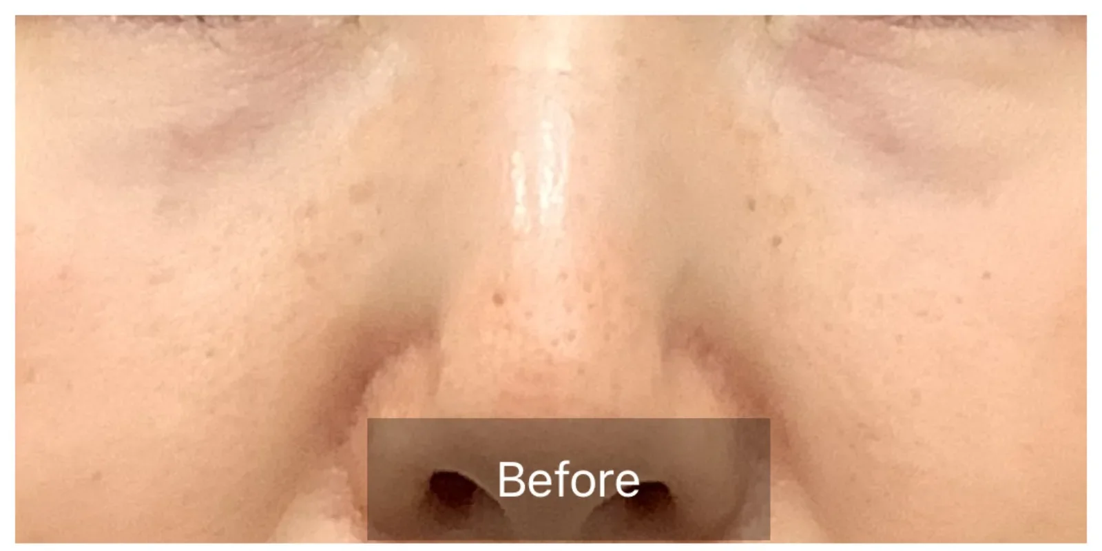 リズネ 目元 症例A Before