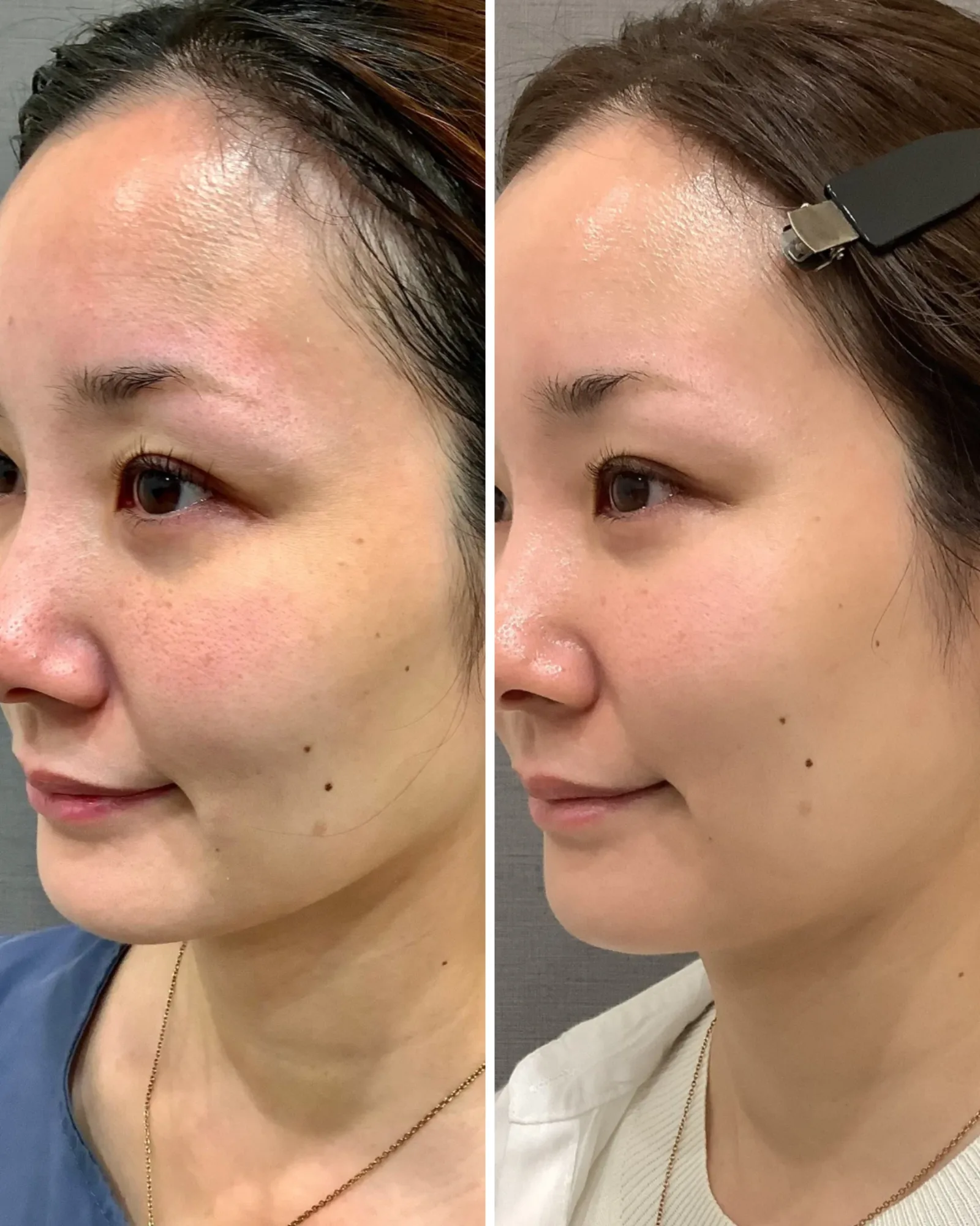 肌育注射（リズネ） 症例写真 7 — リズネ（目元）