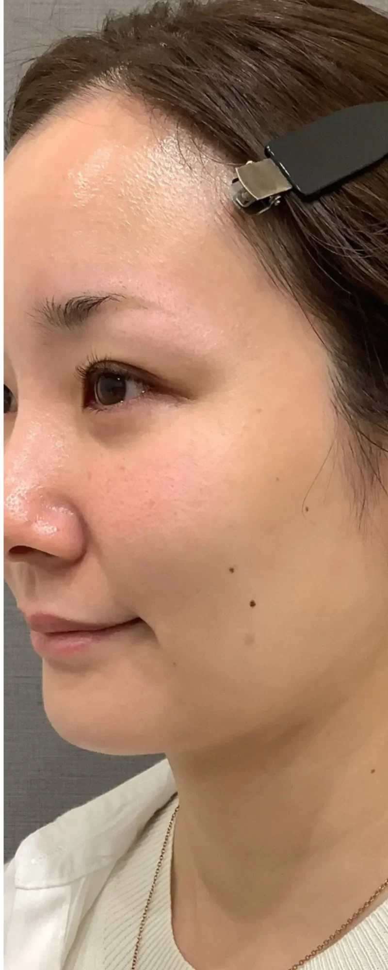 リズネ 目元 症例B Before/After After