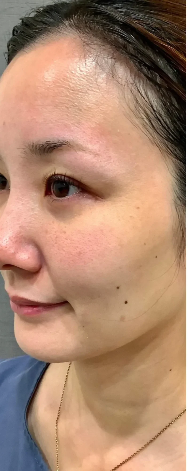 リズネ 目元 症例B Before/After Before