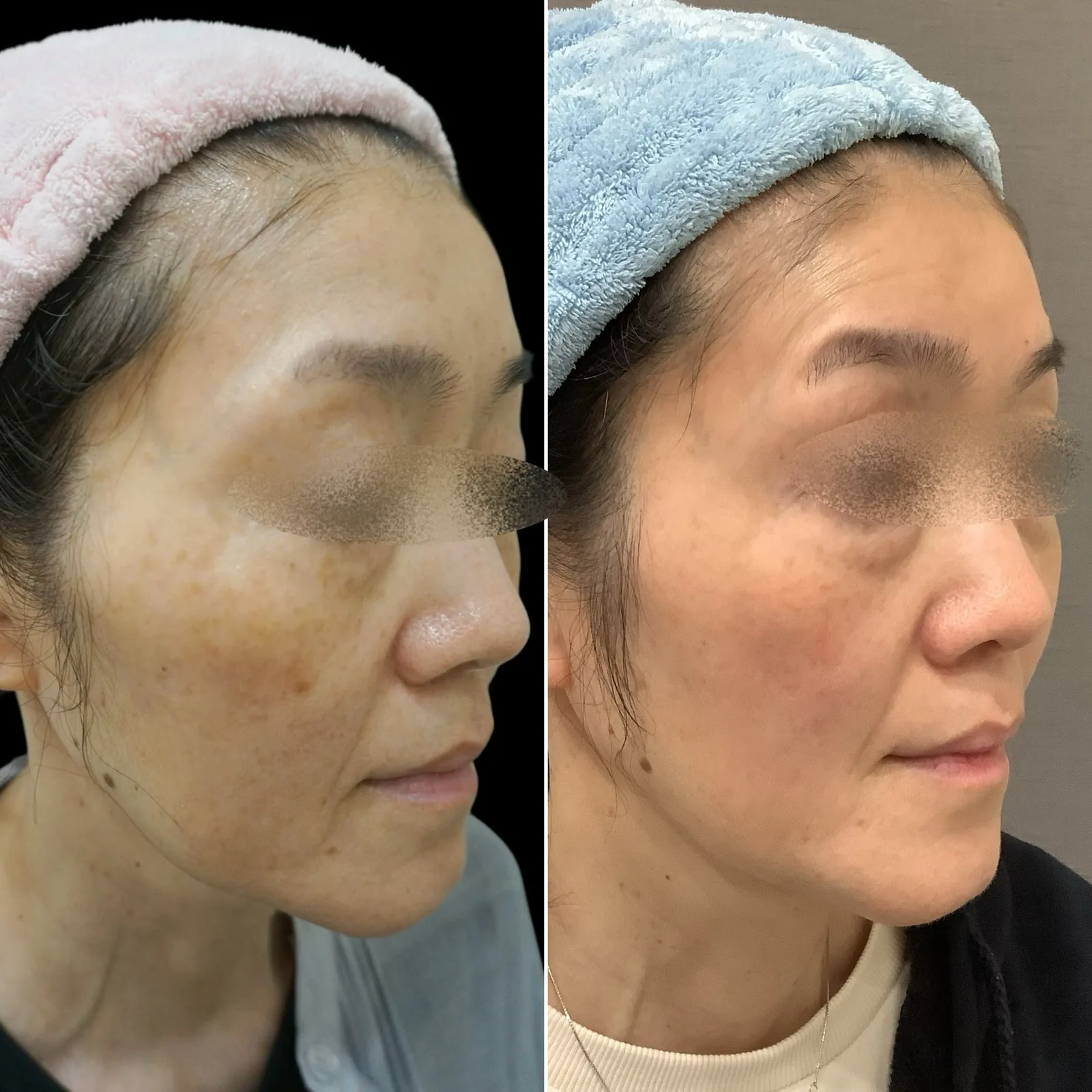 ステラM22（IPL光治療） 症例写真 1 — ステラM22 症例1