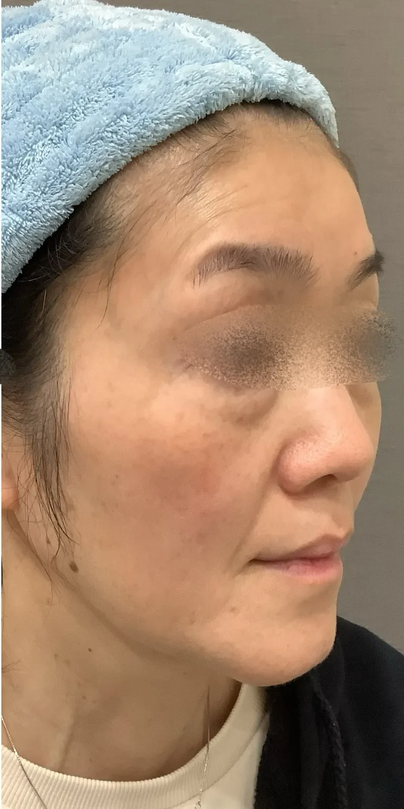 ステラM22 症例1 Before/After After