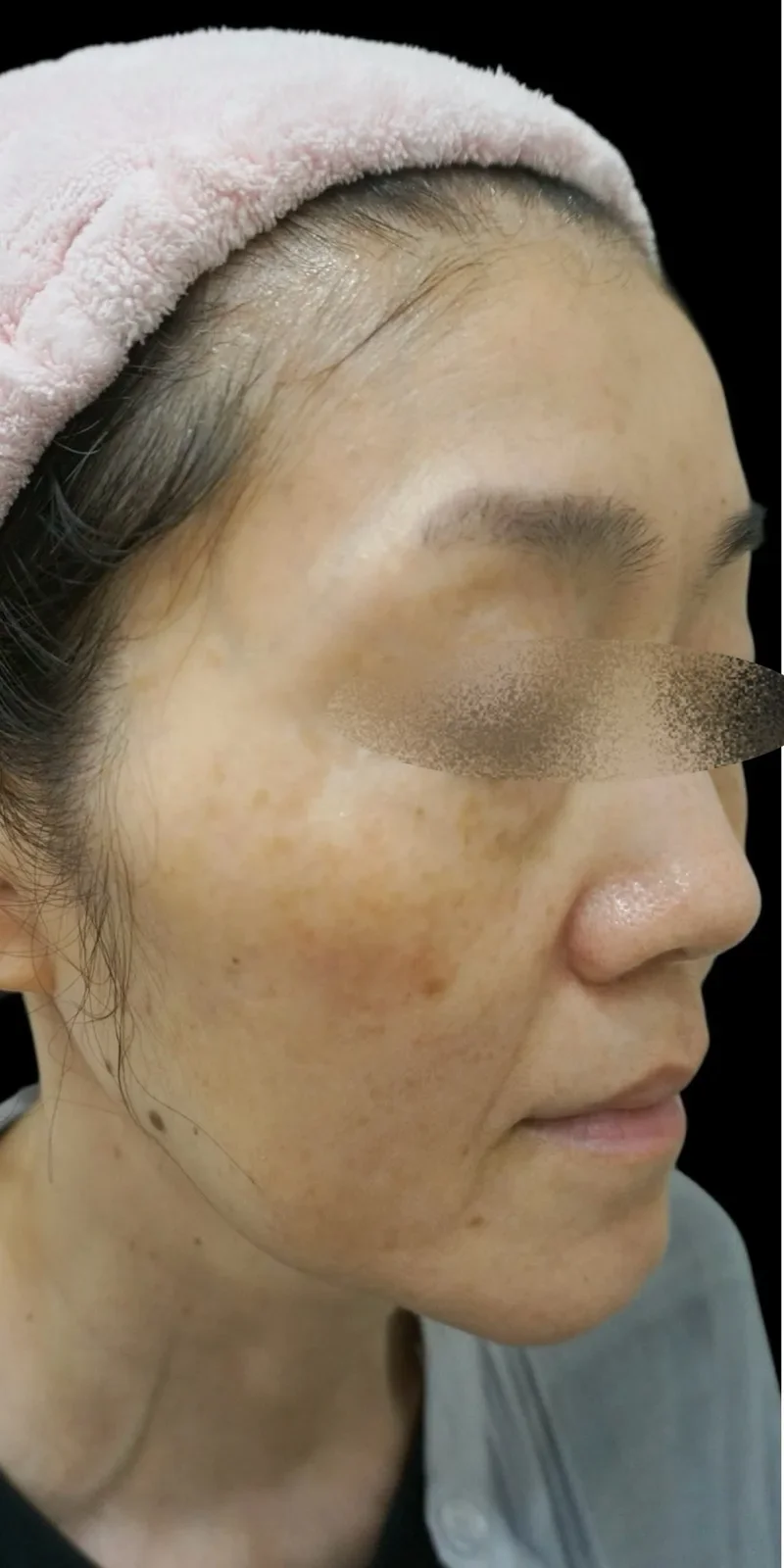 ステラM22 症例1 Before/After Before