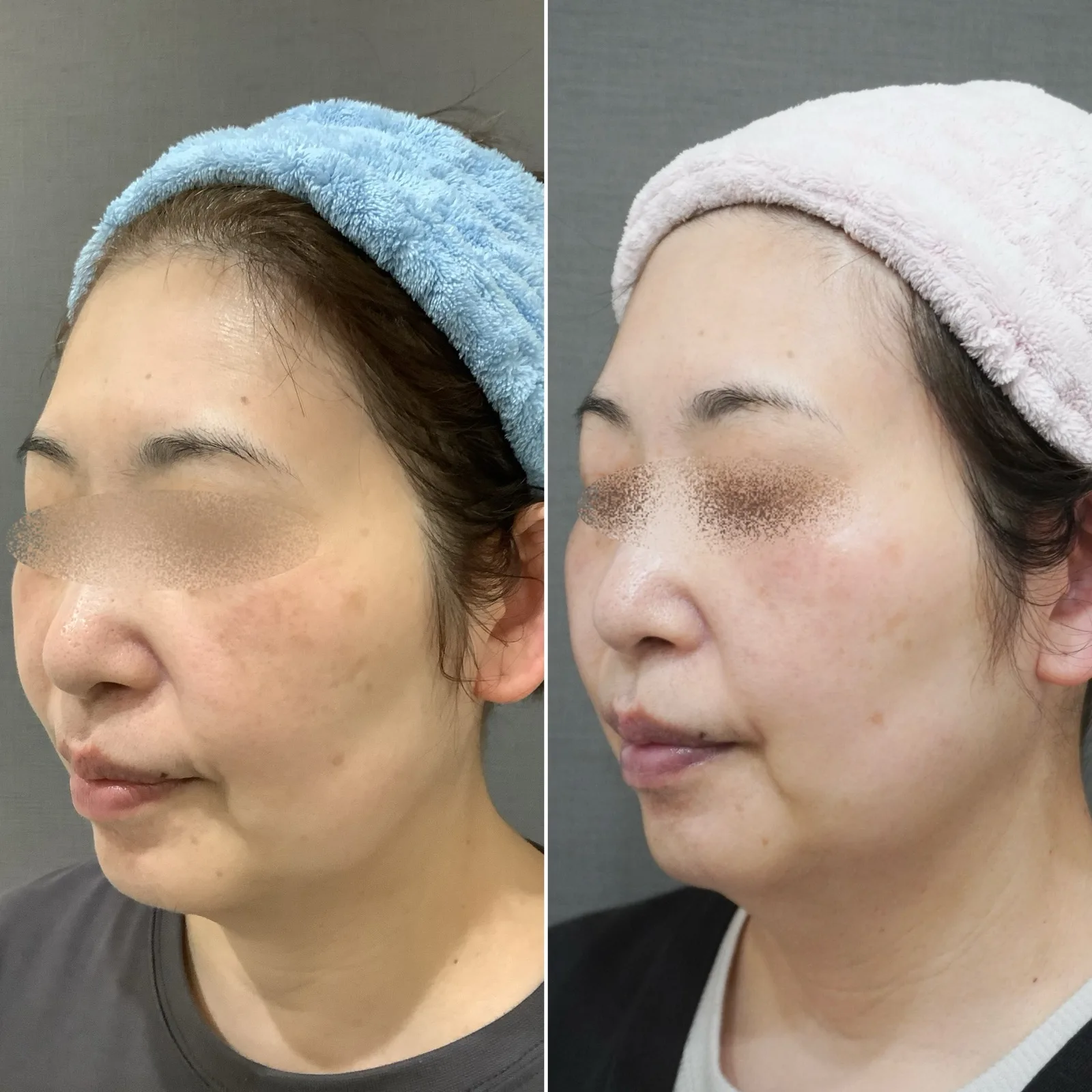 ステラM22（IPL光治療） 症例写真 2 — ステラM22 症例2