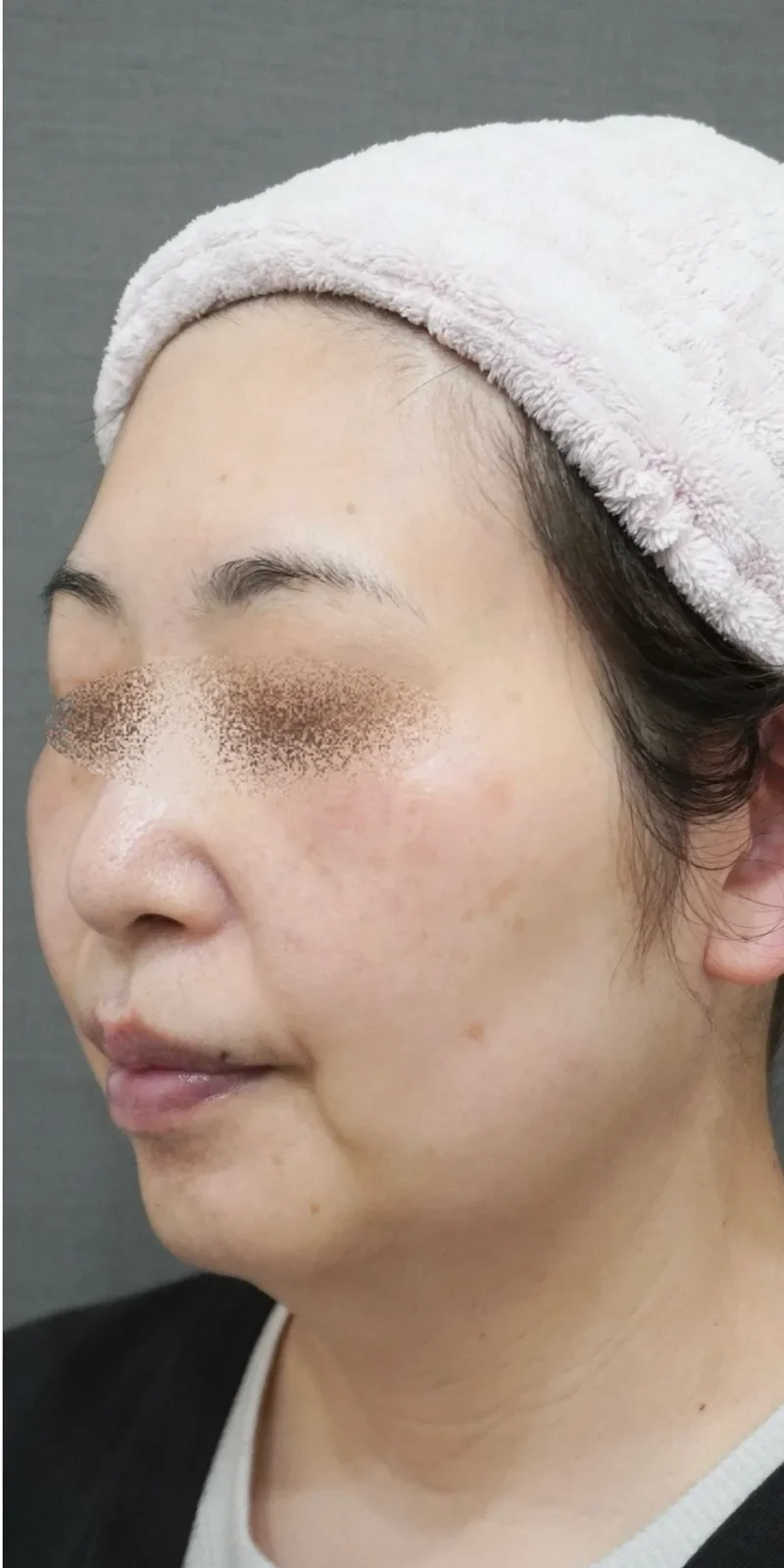 ステラM22 症例2 Before/After After