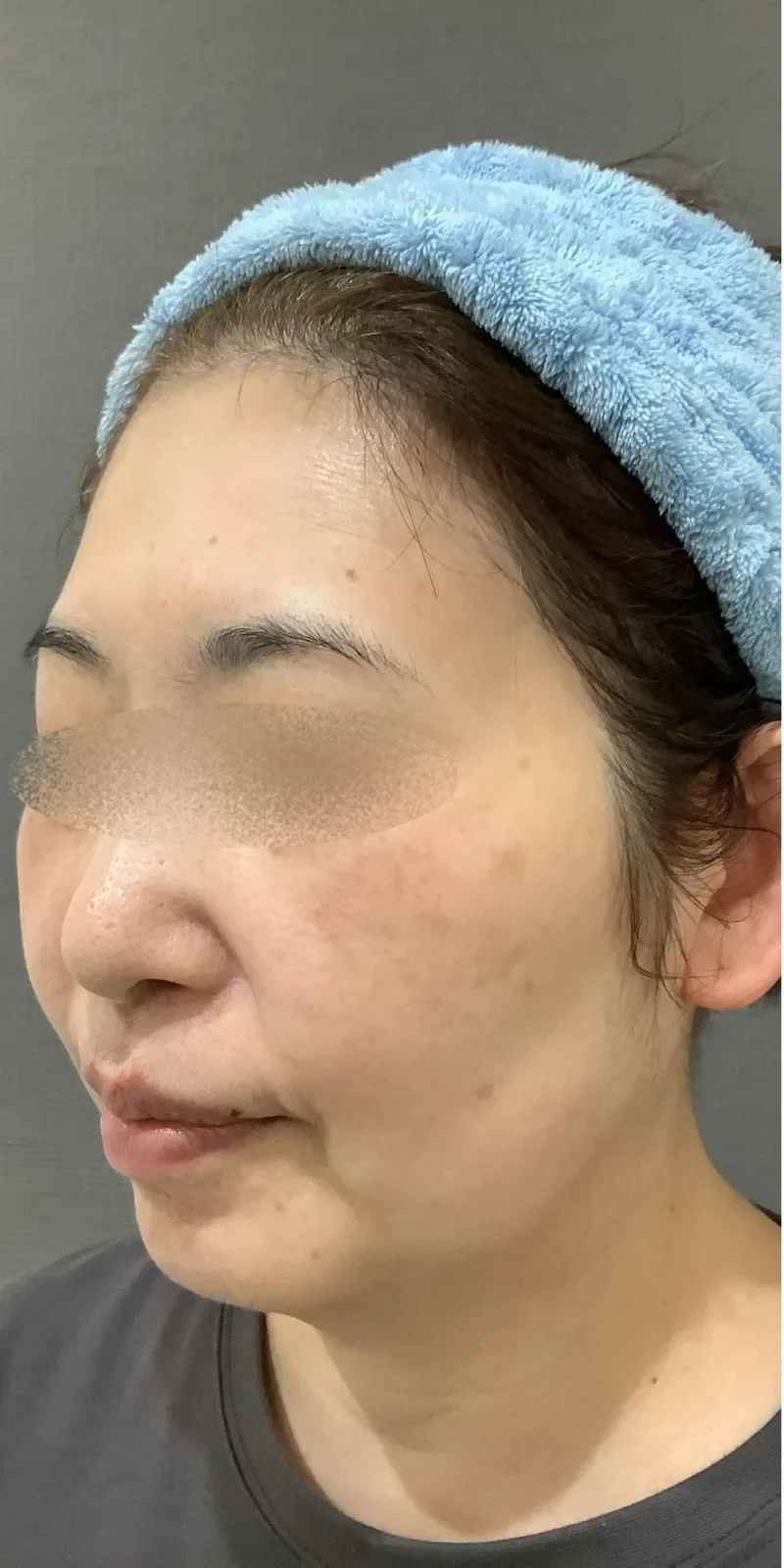 ステラM22 症例2 Before/After Before