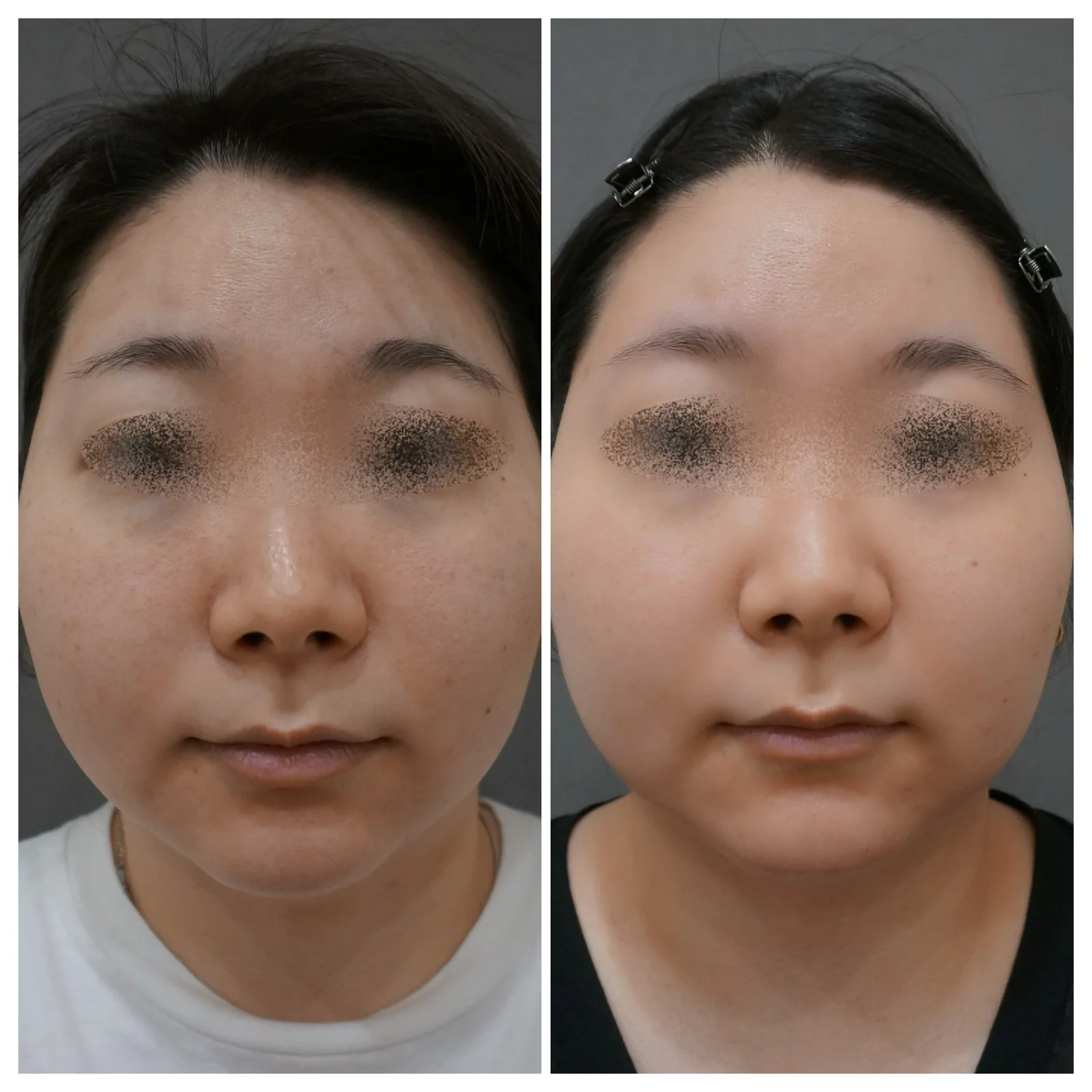 ステラM22（IPL光治療） 症例写真 3 — ステラM22 症例3