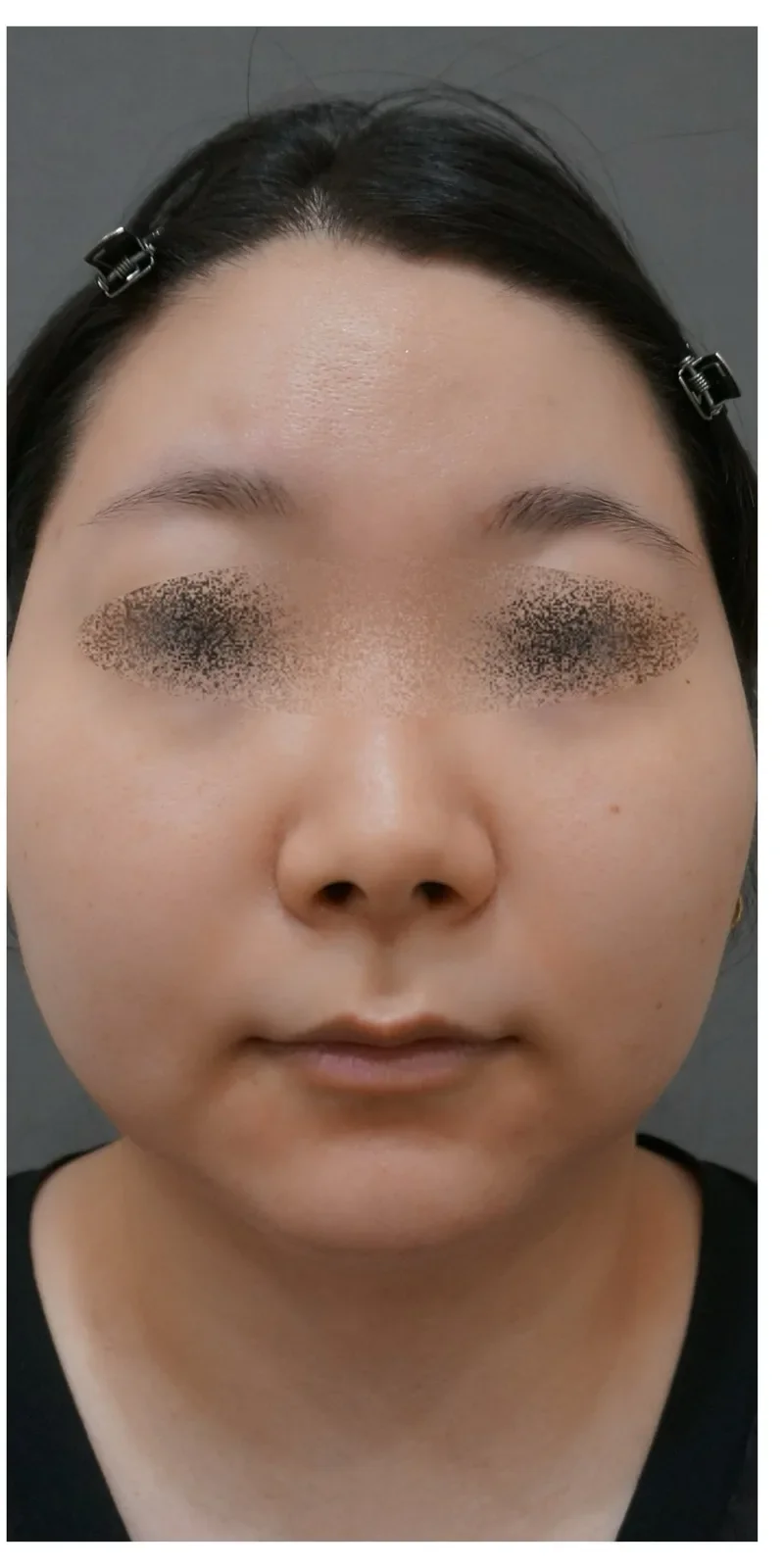 ステラM22 症例3 Before/After After