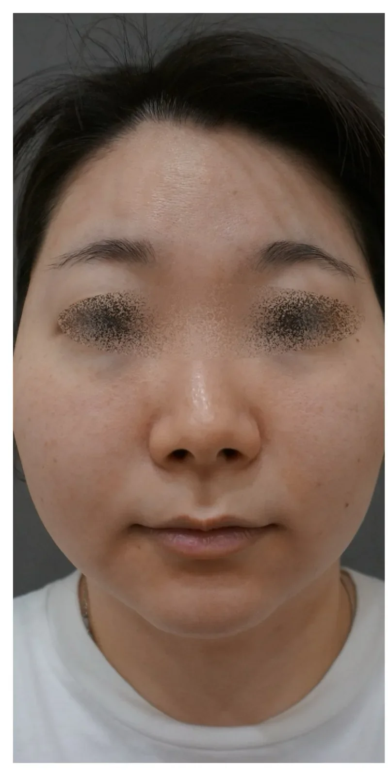 ステラM22 症例3 Before/After Before