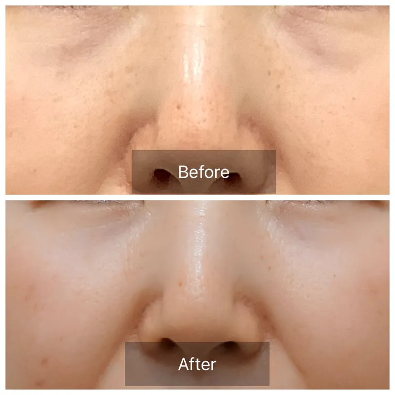 ジェネオXの症例 — 毛穴・肌質改善の実例と施術のしくみ