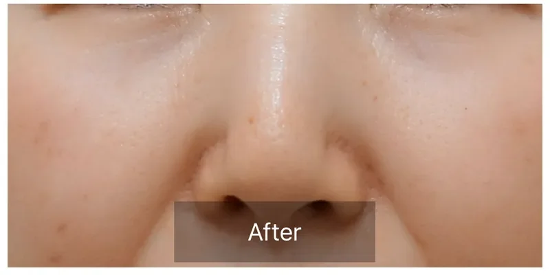 ジェネオX 毛穴・肌質改善の症例 After