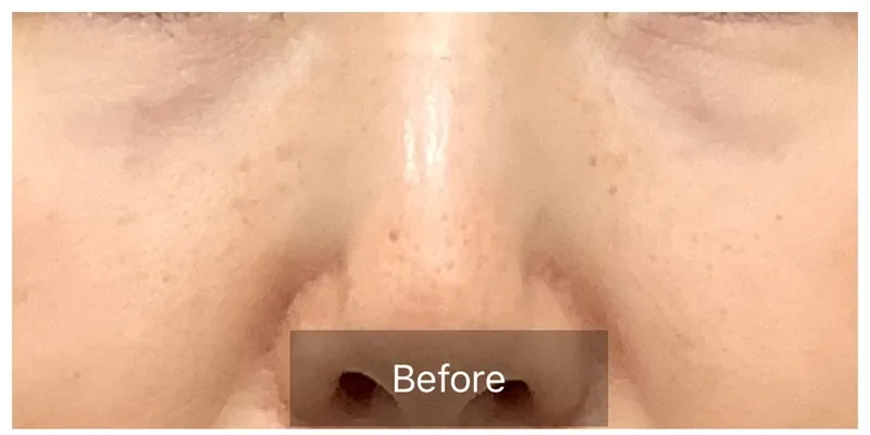 ジェネオX 毛穴・肌質改善の症例 Before