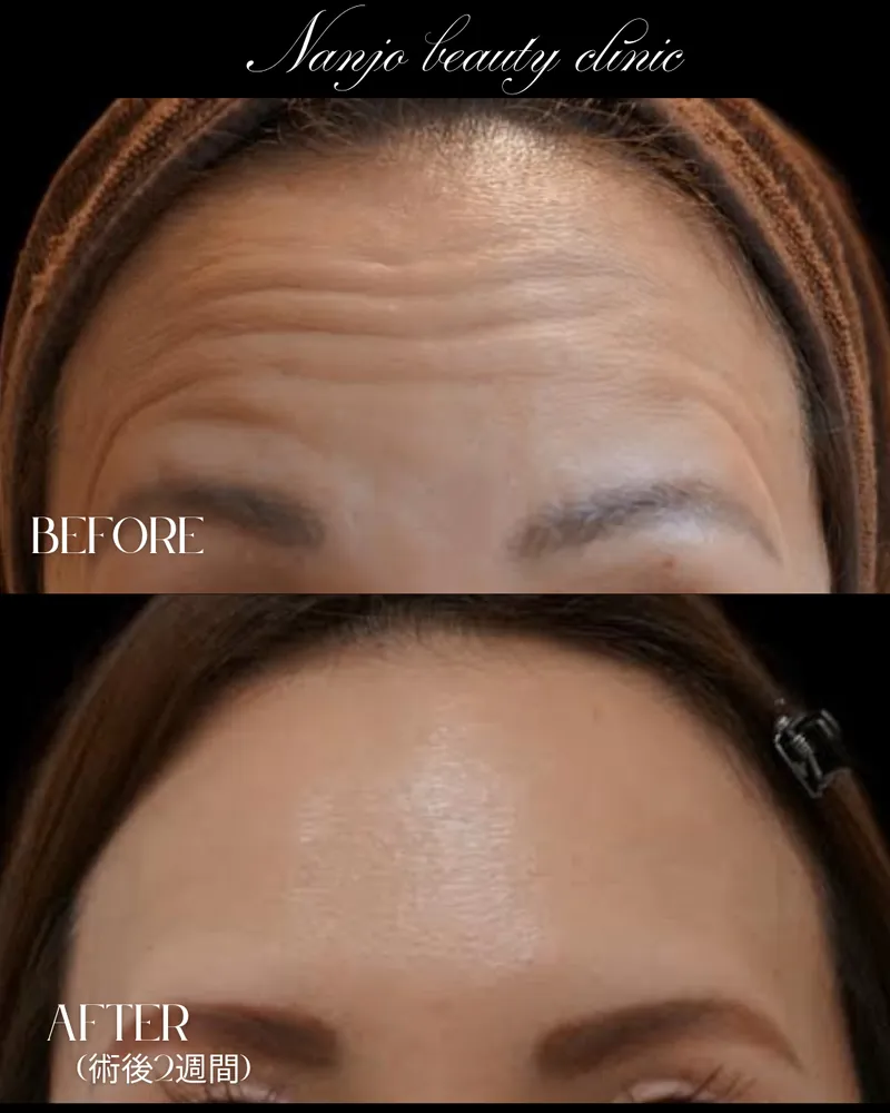 ボトックス（シワ取り・エラ改善注射）とは — 効果・持続期間・ダウンタイムを医師が解説