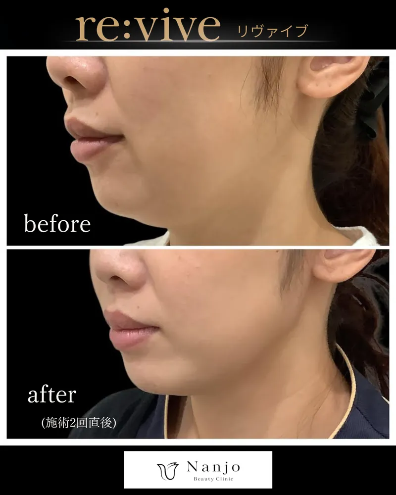 リヴァイブとハイフの違い｜たるみ治療の選び方｜南條ビューティークリニック