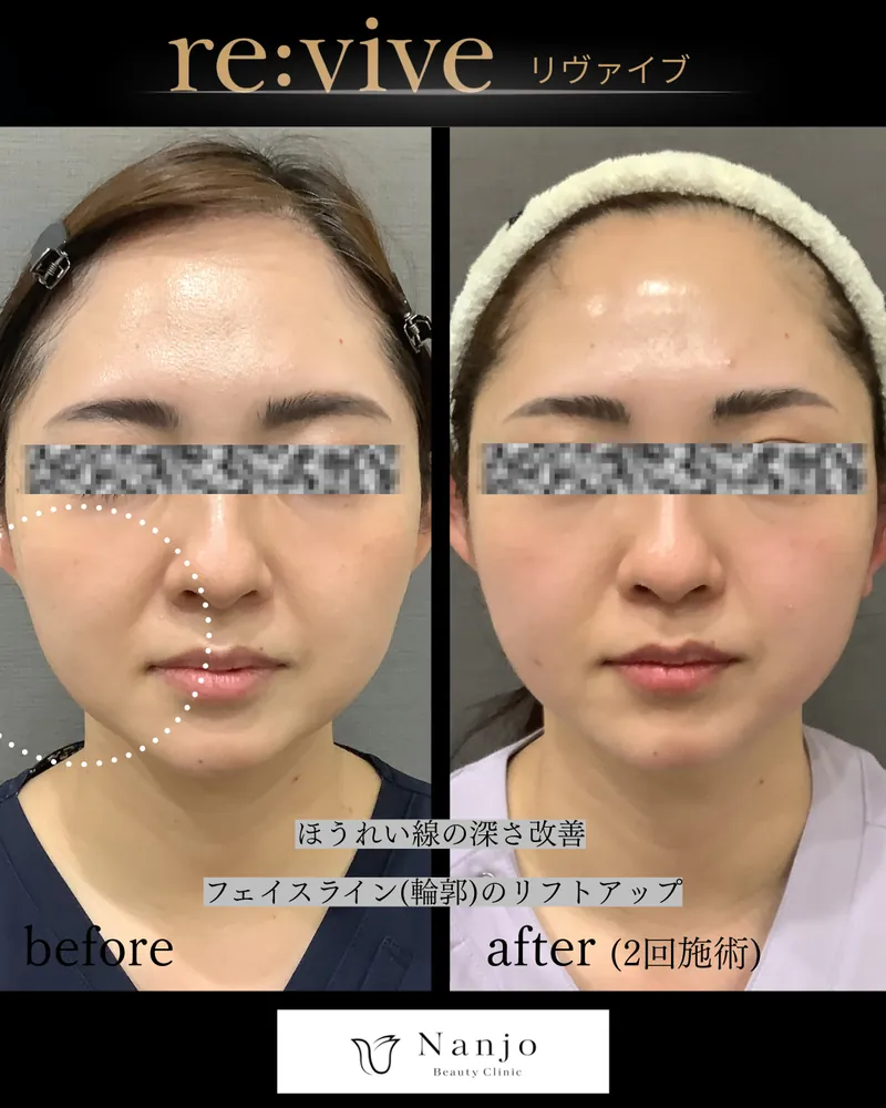 ハイフで物足りなかった方へ — マイクロ波たるみ治療「リヴァイブ（Re:vive）」とはの記事画像