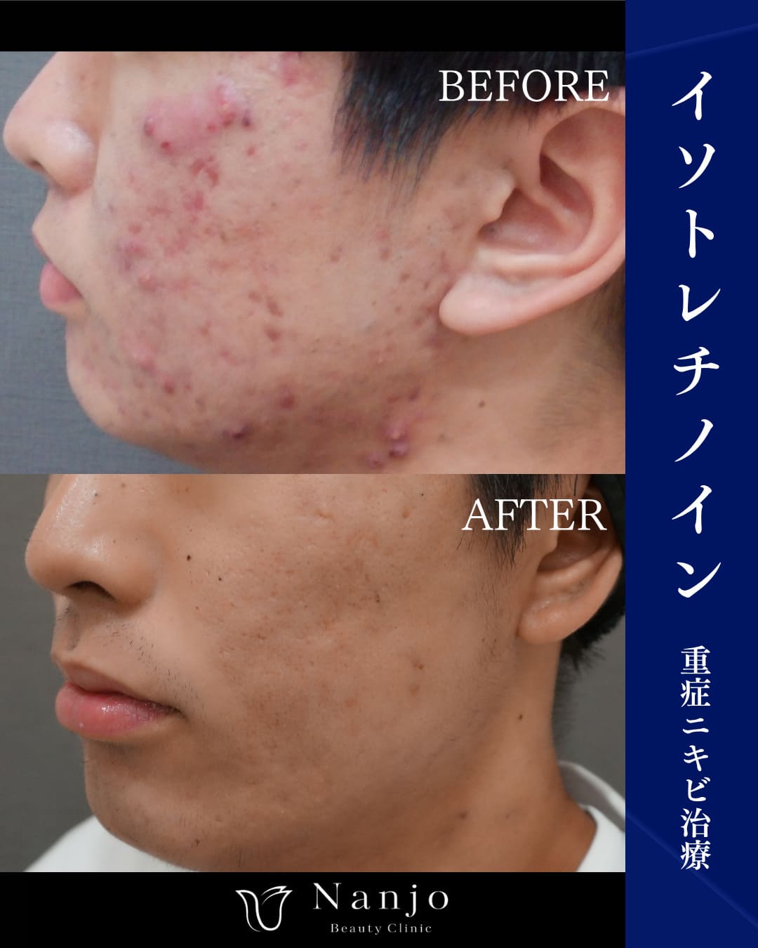 イソトレチノイン